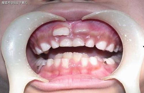 7岁男童因多生牙拔牙昏迷40天,难道父母不该好好反思下么