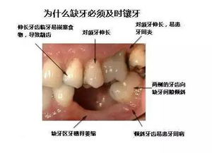 2018 11 06 百会口腔 牙齿缺失不补的危害 .