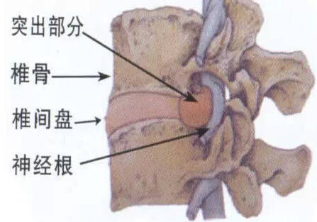 17岁少年腰椎间盘突出无法下地,好好的腰咋会说突就突了