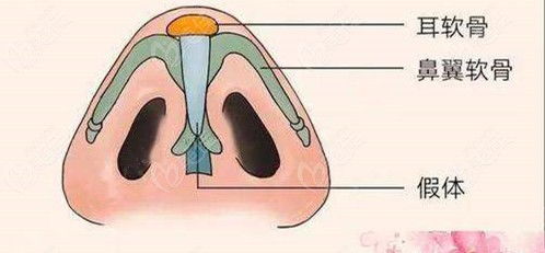 耳软骨膨体综合隆鼻不满意可以只取鼻头的耳软骨吗