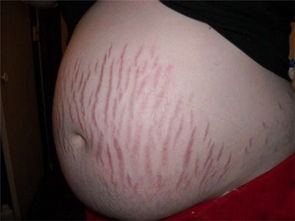 妊娠纹怎么预防 如何预防妊娠纹 3种方法来预防妊娠纹