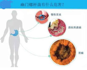 体检发现幽门螺杆菌阳性该怎么办 就意味胃癌吗 