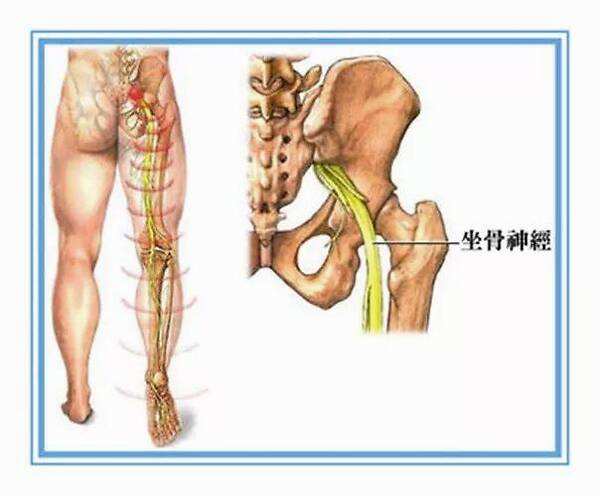 坐骨神经痛的症状