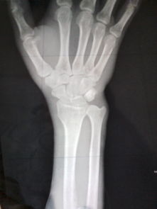 这是我的右手手掌骨头的照片,请问我的右手伤的严重吗 手被铁压了,还肿了,现在肿基本消了 