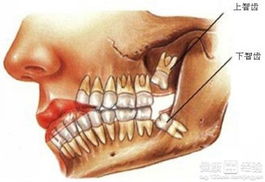 牙齿正畸必须要拔智齿吗排齐门牙会导致曾经断裂的牙齿受伤吗(正畸拔牙会拔门牙吗)