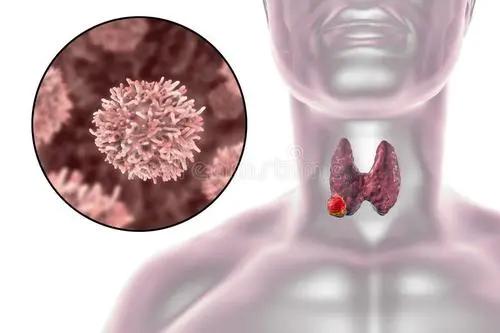 决定甲状腺癌术后会不会复发 这4点做好才是关键原因