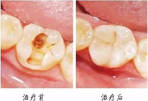 医生,我牙疼 什么是根管治疗 做完根管治疗后结果是什么