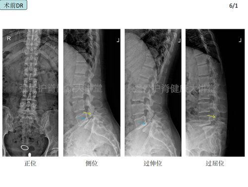 腰椎2度滑脱可以做微创手术吗