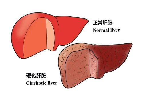 肝纤维化是什么 是否可以逆转