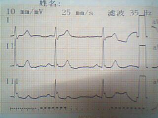请心电图专业人看看 