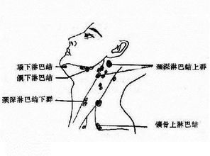 股腹沟淋巴结炎