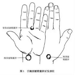 腱鞘囊肿冷知识</title>
<meta name=