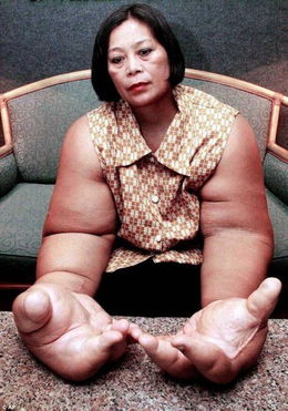 泰女子患罕见病致其拥有 世界上最大手臂 