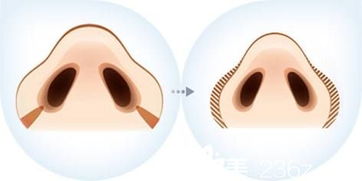 蒜头鼻怎么办 用鼻翼缩小术或者自体软骨隆鼻轻松解决
