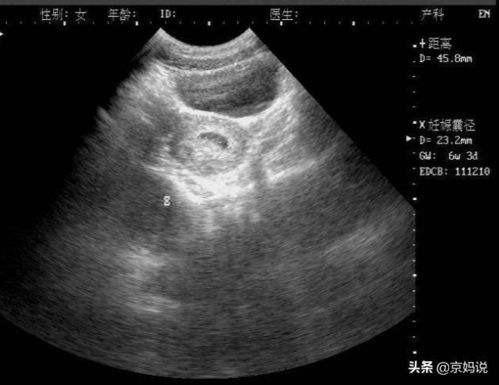 原创孕囊偏小有影响吗？若不对此上心，胎心胎芽也很难出现
