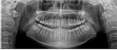 在口腔诊所拍的 牙片 ,对身体有害吗