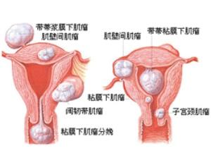 卵巢囊肿的食疗方法有哪些