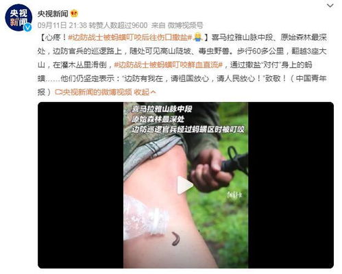 心疼 边防战士被蚂蟥叮咬后往伤口撒盐