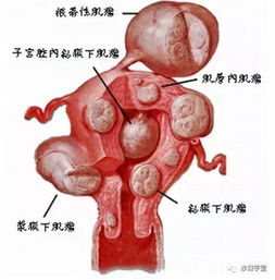 为什么子宫肌瘤切掉了肝上又长囊肿