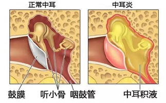 儿童患中耳炎有什么表现 有哪些治疗方法 