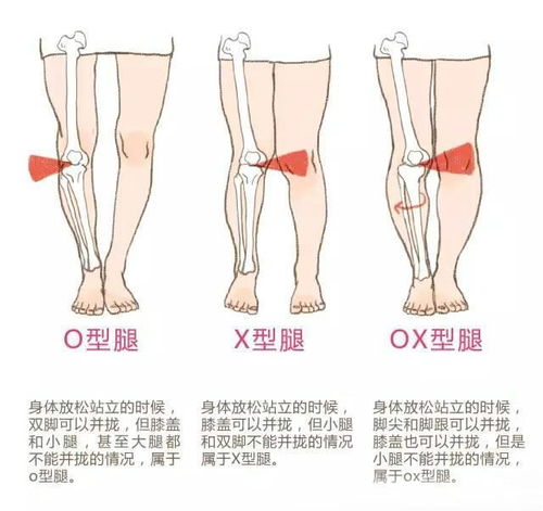 腿型矫正系列 每天10分钟,这个动作可以帮你轻松矫正XO型腿