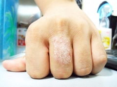 手部湿疹的预防方法(手部湿疹能自愈吗)
