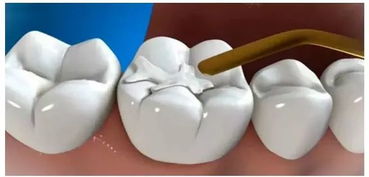 补牙后能维持多久？