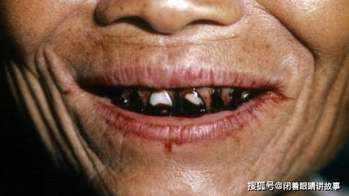 致癌物槟榔卷土重来,割舌头切牙床,6000万国人陷危险之中