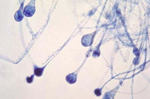 近两月来,毛霉菌感染在印度激增,超4300人死亡