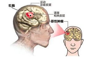 男性脑癌危害都有哪些 