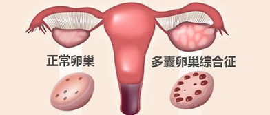 多囊卵巢长期不治疗会有什么后果？这些隐患你知道吗？