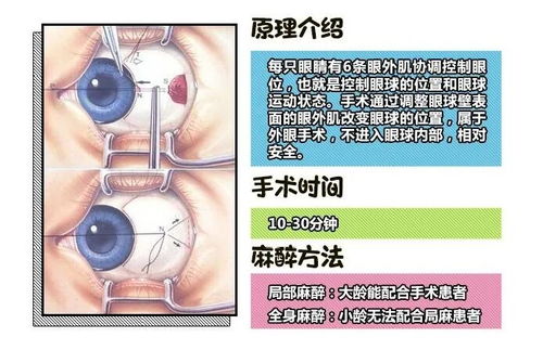 两岁宝宝眼睛有点斜视,要不要做斜视手术治疗