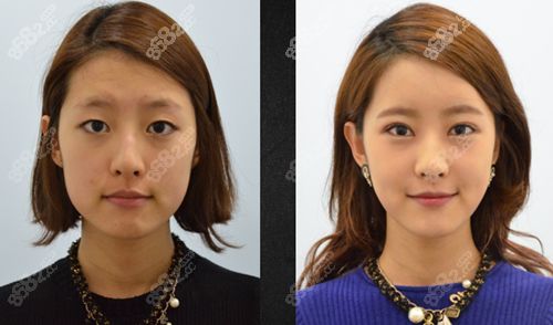 面部凹陷如何恢复 看韩国必当归做脂肪填充案例效果不错