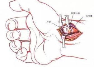 冠心病患者慎选血管支架,能救命又长寿