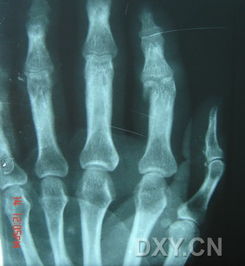 精致的小手术分享近节指骨远端骨折 图片欣赏中心 急不急图文 Jpjww Com