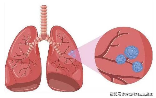 肺结节能彻底治愈吗