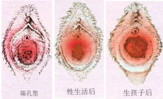 详解：女性阴道内处女膜的细致变化