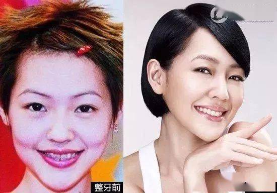 林允回应我脸型怎么了,整容不如整牙 郑爽baby整完之后美若天仙