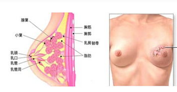 乳腺囊肿患者怎么饮食