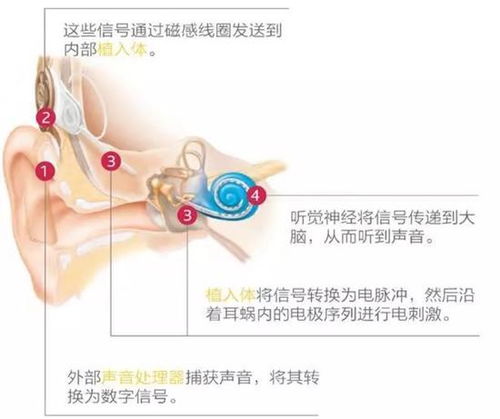 上海儿童医院全面复工 已开展20例人工耳蜗植入手术 