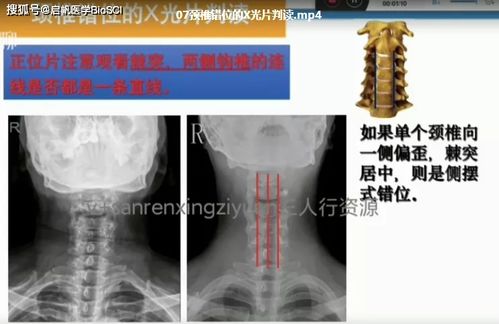 资料 常见脊柱疾病解读课程,康复人应该掌握的影像学判读