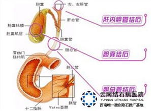 肝内胆管结石疼痛 肾结石 胆结石 保胆保肾取石 亚洲专业治疗结石病的医院 