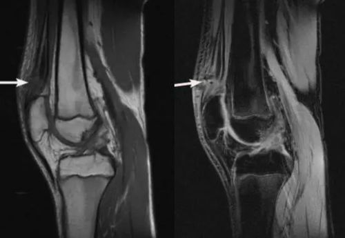 膝关节各种损伤的MRI表现大集合