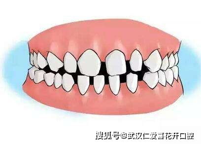 这6类牙齿需尽快做牙齿矫正 不矫正遗憾一辈子