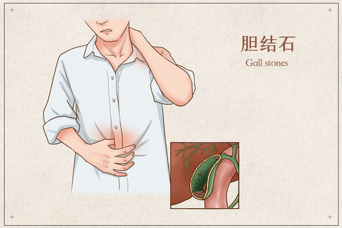 胆结石的发生,跟6个原因有关 日常多吃6种食物,可防治胆结石