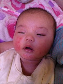 宝宝湿疹症状，婴儿湿疹症状有哪些