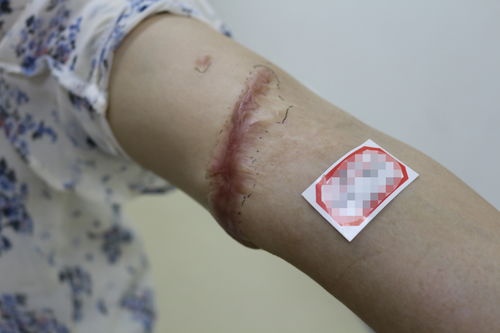 济南现代皮肤病医院 关于疤痕的治疗