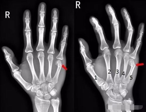 右手骨折拍片图片 搜狗图片搜索