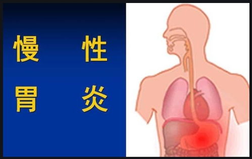 慢性胃炎 与消化性溃疡 胃癌的清晰鉴别