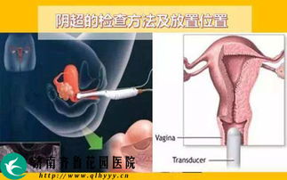 怀孕做阴超会流产吗(怀孕了做阴超检查会对小孩有影响吗)